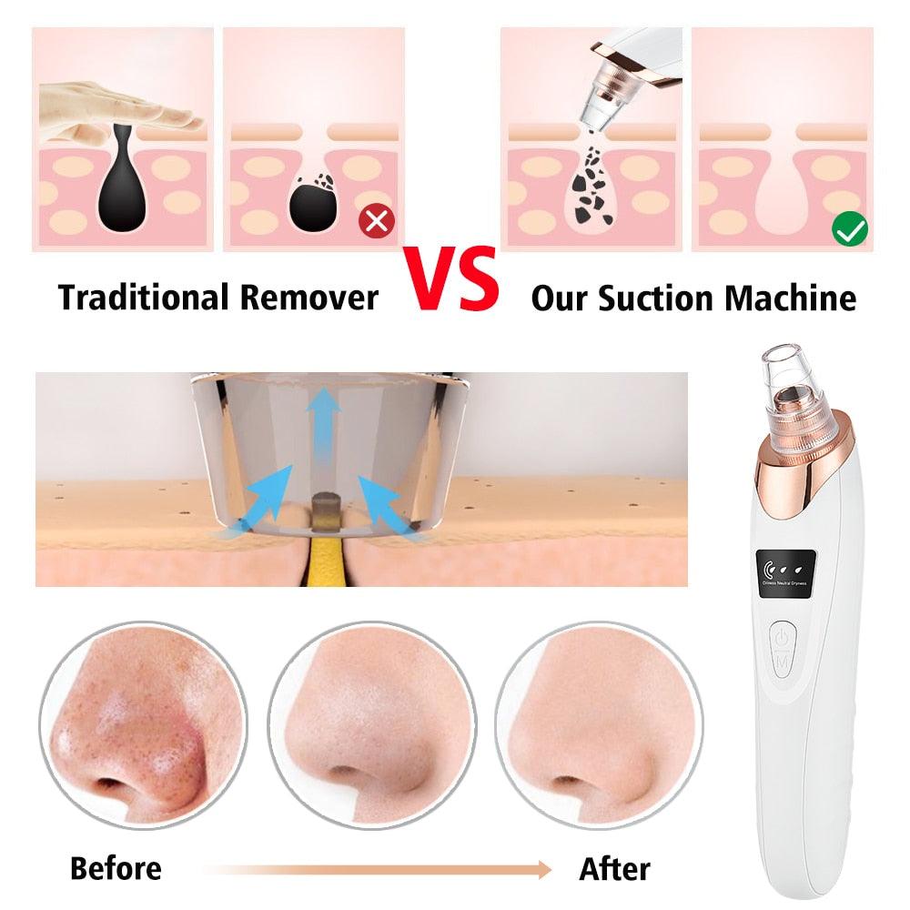 Beauty Electric Blackhead Remover - All In The Bag 